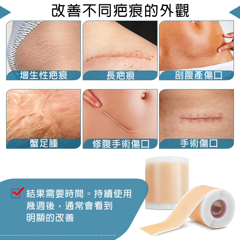 矽膠去疤修復貼 自粘疤痕膠帶 傷口隱形貼 淡化除手術疤痕、剖腹產傷疤等 (4cm x 1.5m)