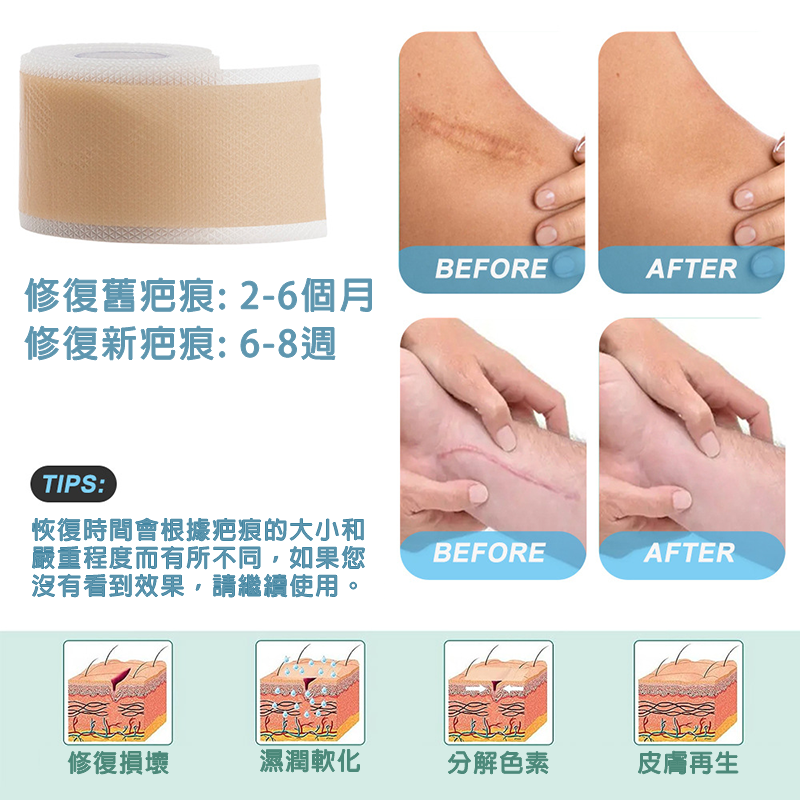 矽膠去疤修復貼 自粘疤痕膠帶 傷口隱形貼 淡化除手術疤痕、剖腹產傷疤等 (4cm x 1.5m)
