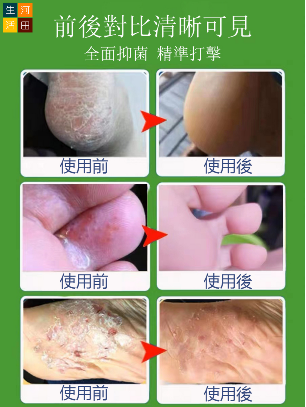 日本東京生物足部抑菌噴霧(30mL)|改善腳臭 防脫皮，足癬，爛腳跟 抑真菌 止腳汗除腳氣 腳部護理