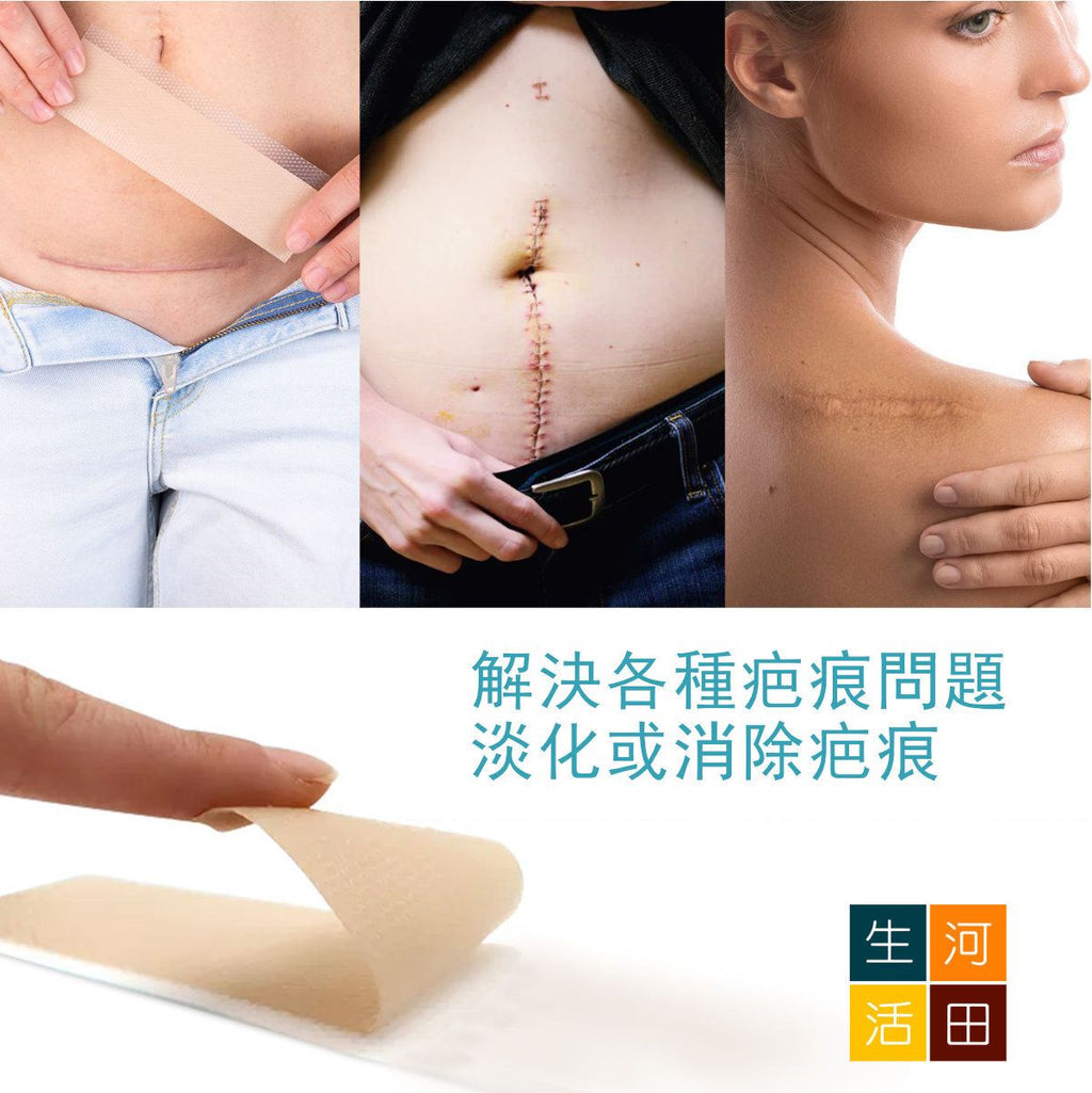 矽膠去疤修復貼(4cm x 1.5m)|肌膚疤痕修復卷|自粘性疤痕膠帶|剖腹產疤痕貼|除疤貼