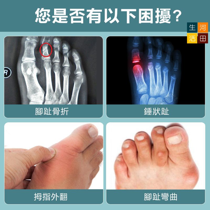 腳趾骨折固定器左右通用(四趾款) | 拇指外翻矯正| 腳趾保護套|分趾器